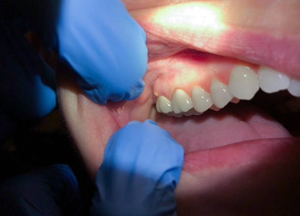 Best Emergency Dentist for Lost Fillings or Crowns in Fayetteville, TN